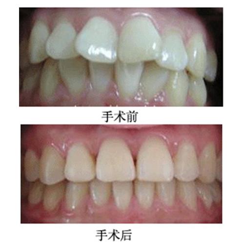 什么时候是牙齿矫正的最佳时机