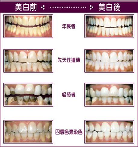 漳州冷光美白牙齿多少钱