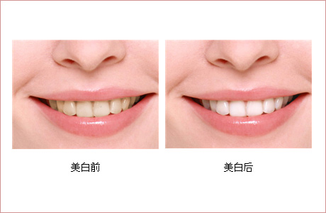 怎么给您的牙齿洗“冷水澡”