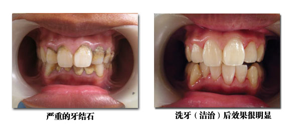 洁牙好吗?