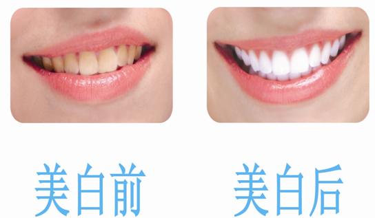 牙齿美白