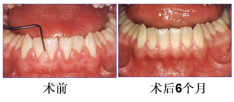 牙周病