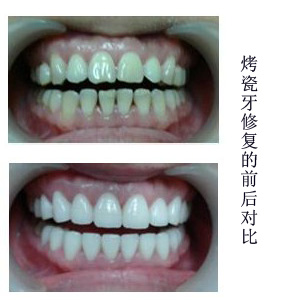 烤瓷牙