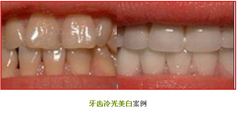 冷光美白