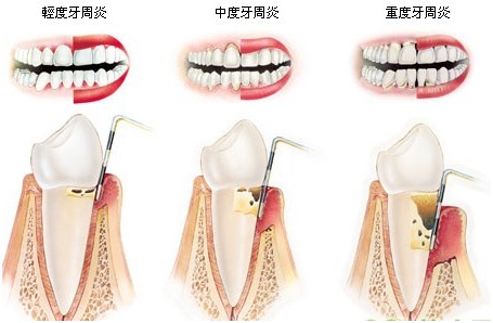 牙周炎