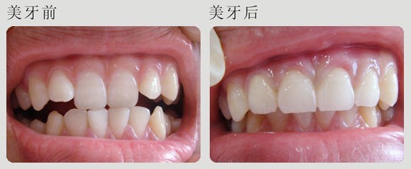 对于牙齿矫正误区有哪些(一)
