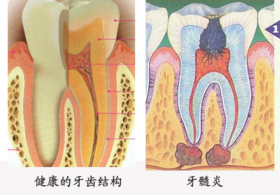 漳州如何自测自己是否患有牙髓炎