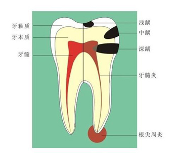 漳州牙髓炎怎么办